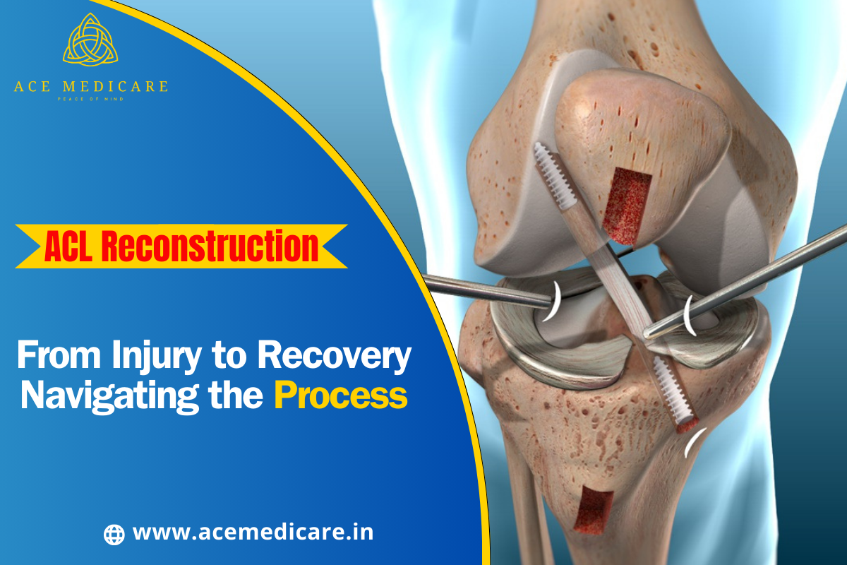From Injury to Recovery: Navigating the ACL Reconstruction Process